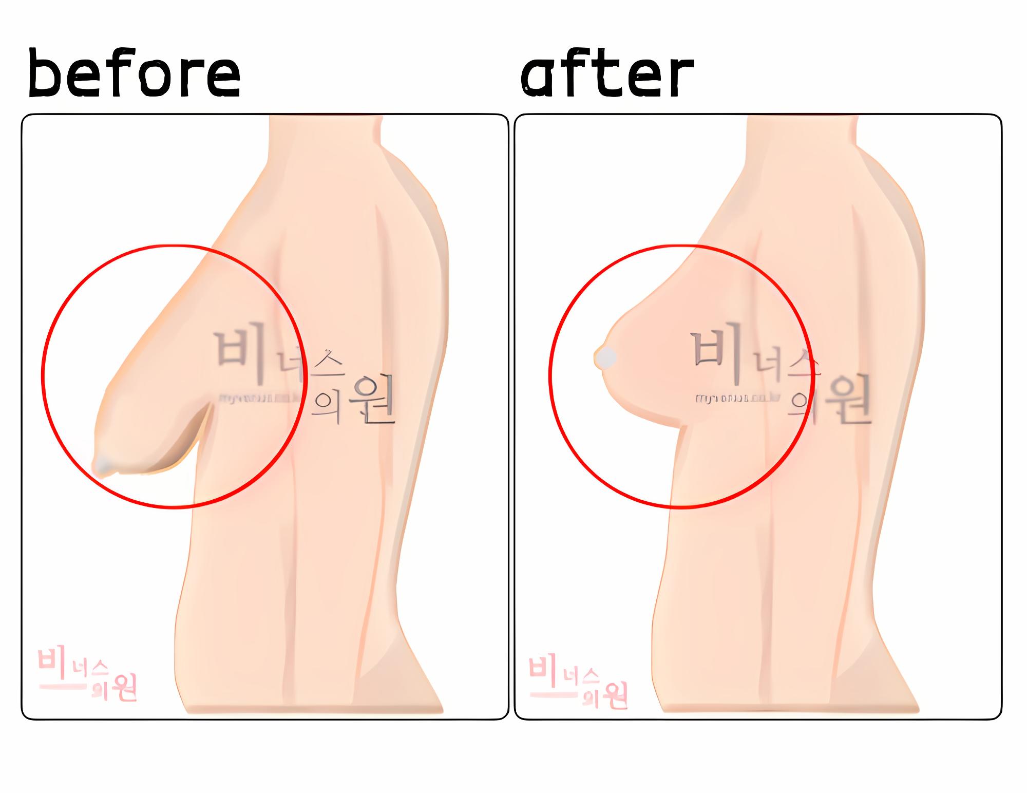 가슴 처짐 정도에 따른 측면 전후 비교 다이어그램