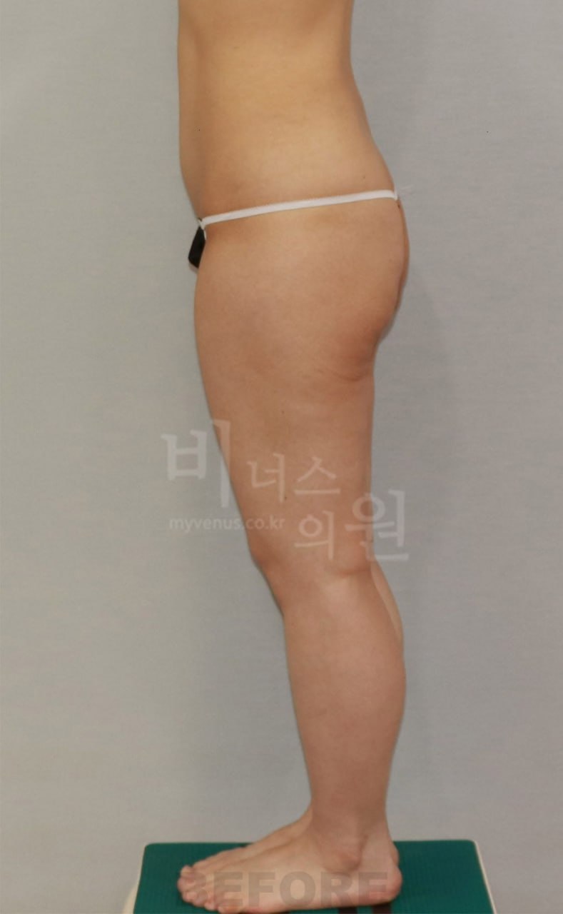 엉덩이 지방흡입 수술 전 우측면 비너스의원