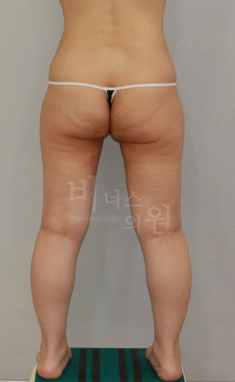 엉덩이 지방흡입 수술 전 후면 비너스의원