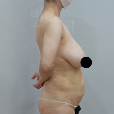 가슴축소 지방흡입 수술 전 측면 (다각도) 비너스의원