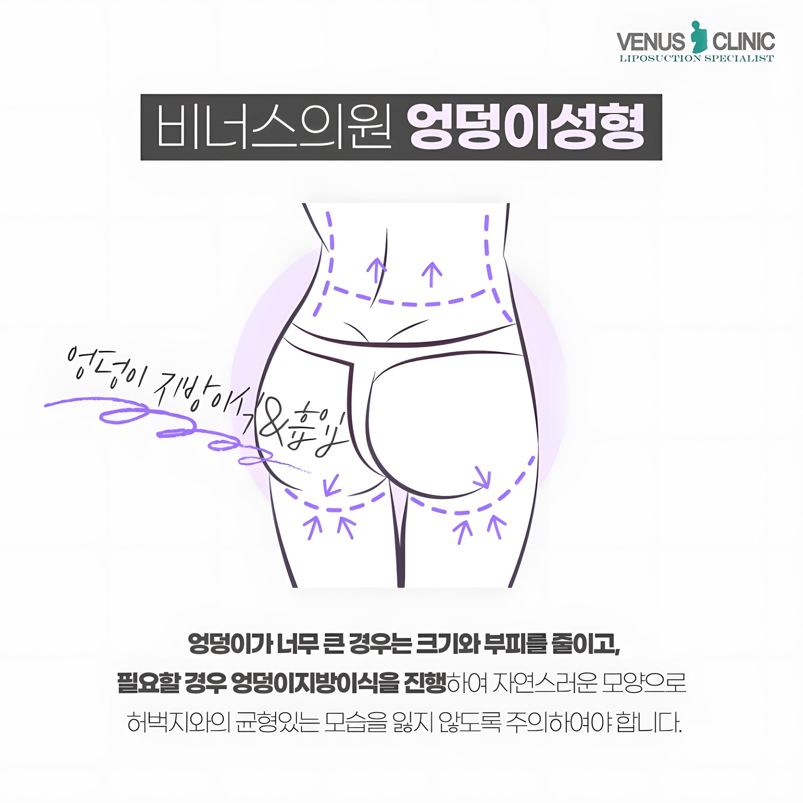 엉덩이 지방흡입 수술 형태 설명 이미지 비너스의원