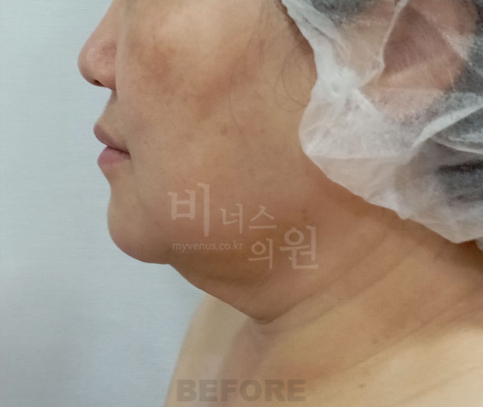 이중턱_얼굴_지방_1.jpg