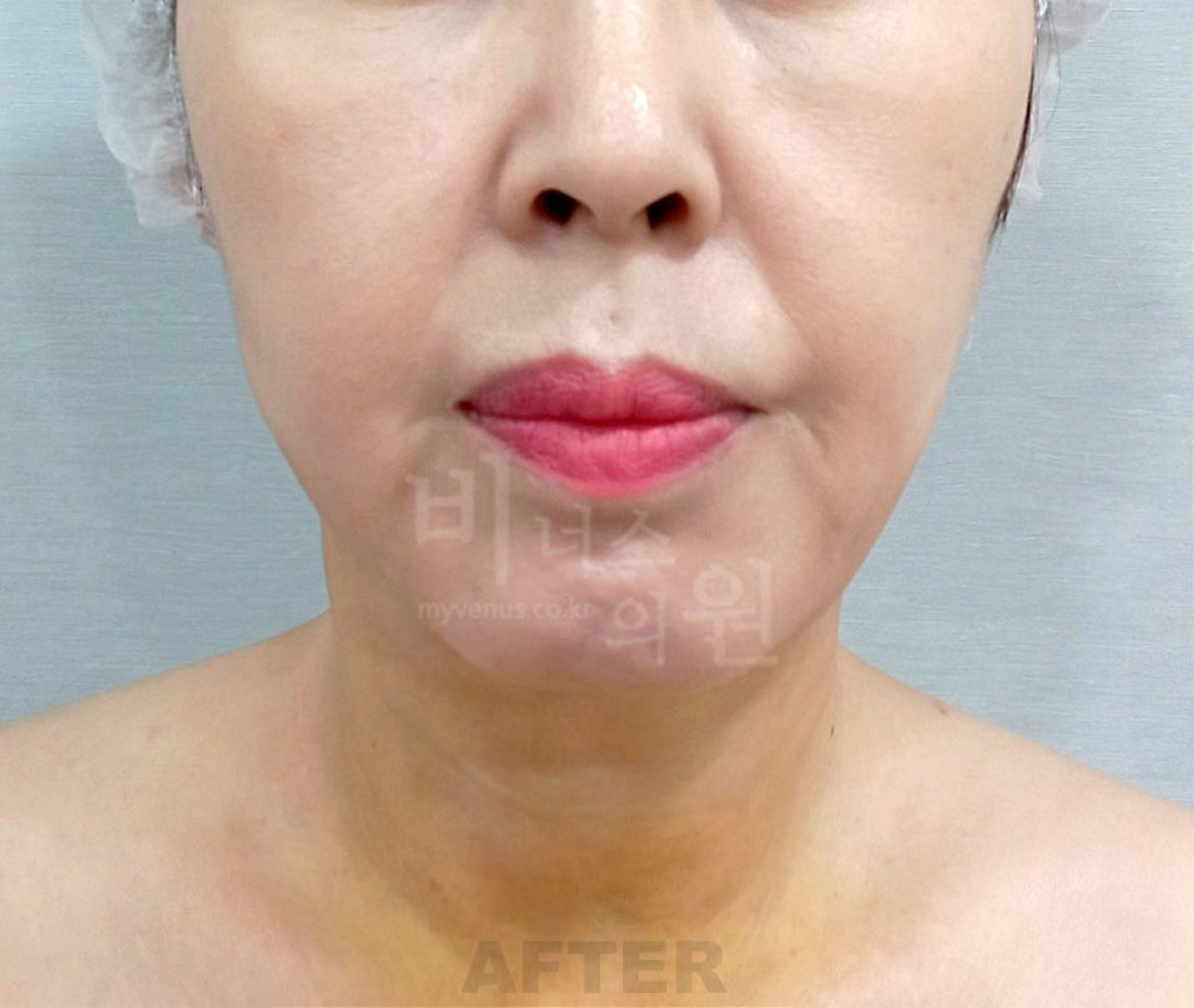 이중턱_목지방흡입 - 복사본 - 복사본.jpg