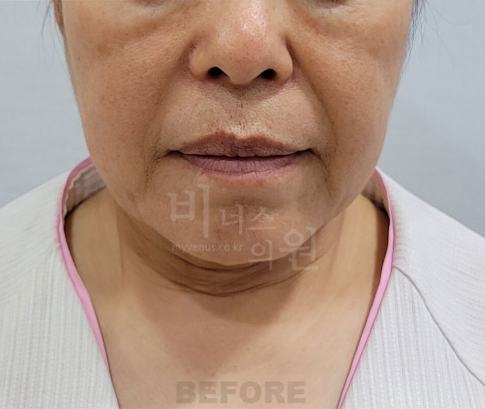 턱 지방흡입 수술 전 정면 사진 - 하안면 윤곽 비너스의원
