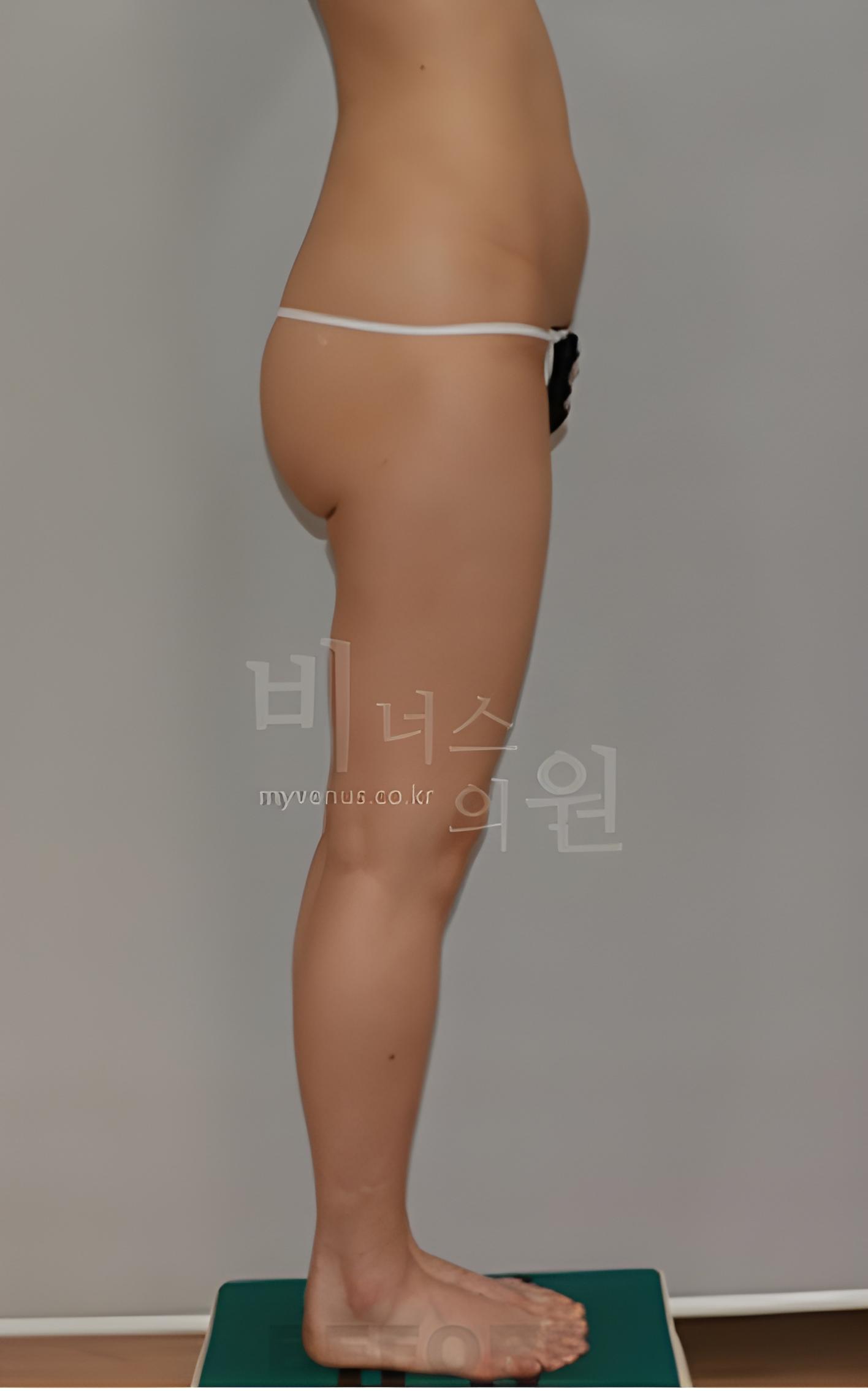 엉덩이 볼륨업 지방흡입 수술 전 측면