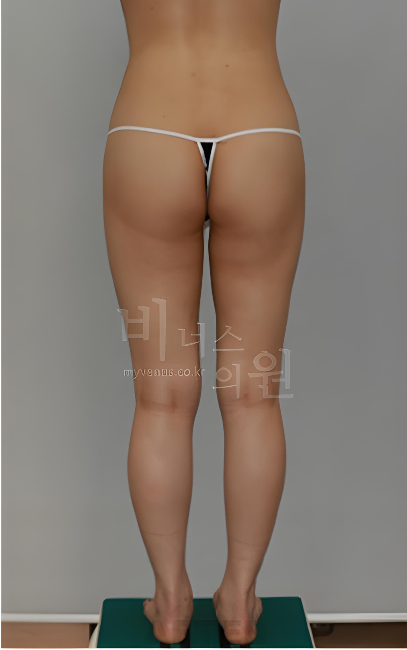 엉덩이 볼륨업 지방흡입 수술 후 후면