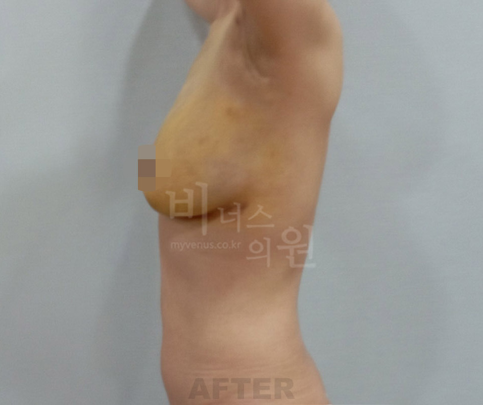 유방하수 표층 지방흡입 수술 후 측면 팔 올린 자세 비너스의원