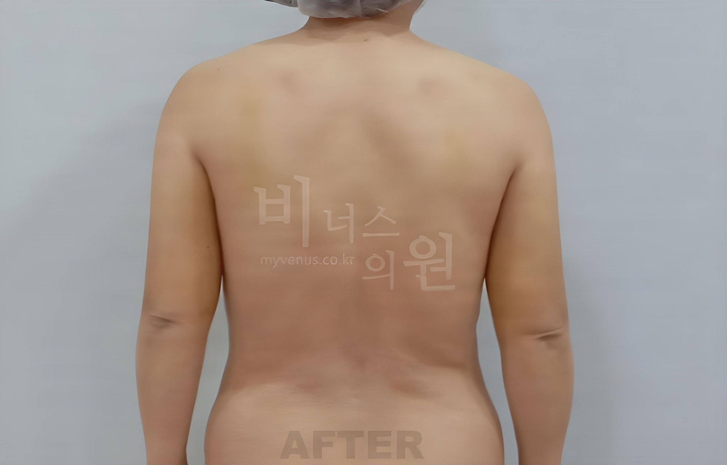 팔뚝 지방흡입 수술 후 후면 팔을 내린 비너스의원