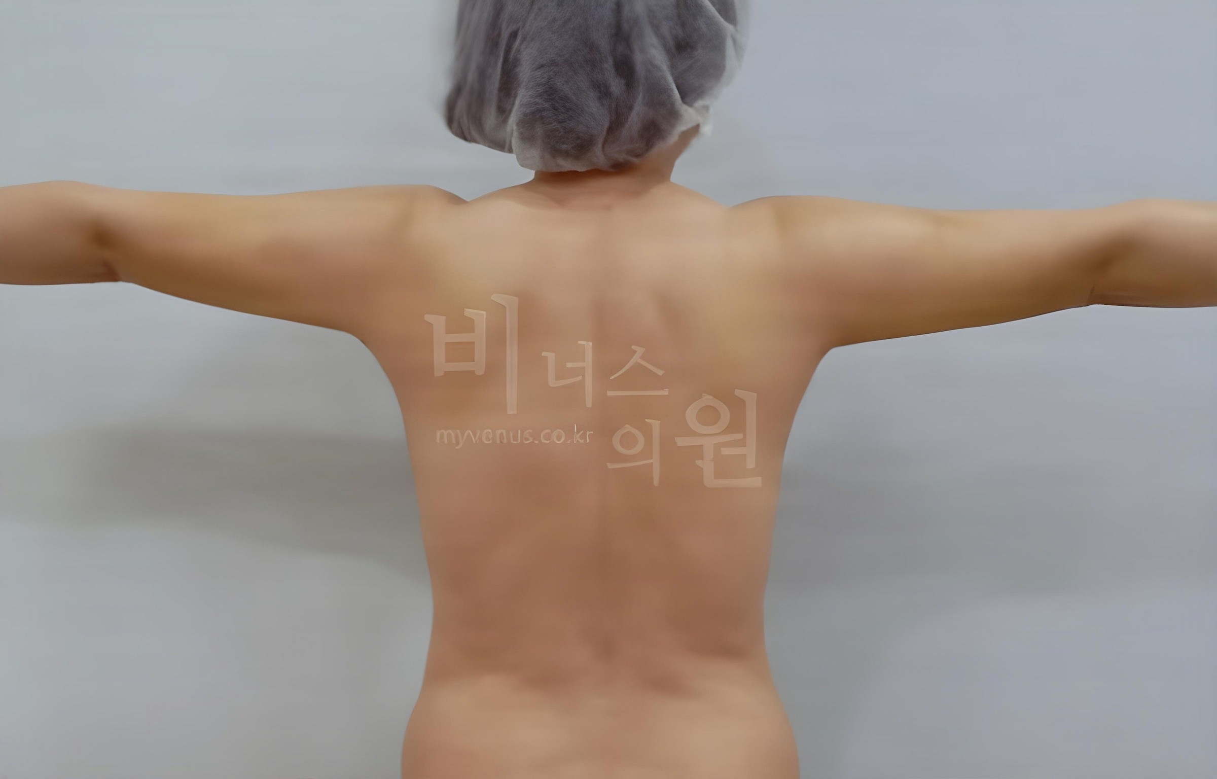 팔뚝 지방흡입 수술 후 후면 팔을 벌린 비너스의원