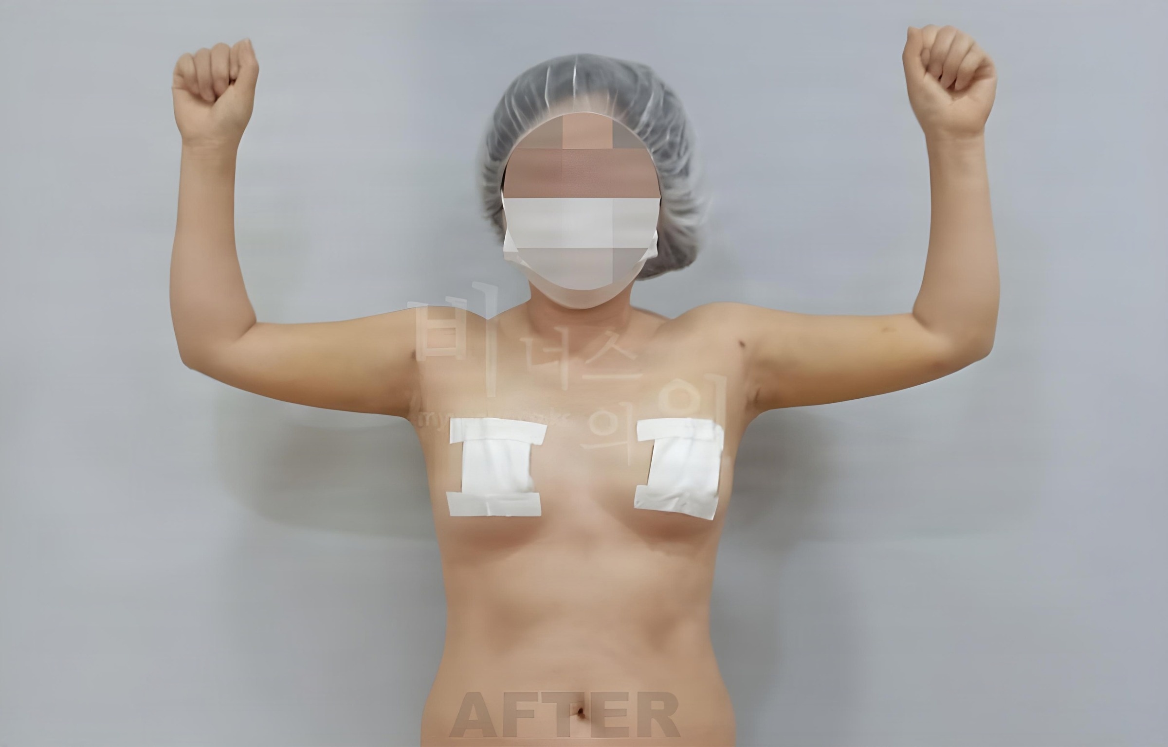 팔뚝 지방흡입 수술 후 정면 팔을 올린 비너스의원