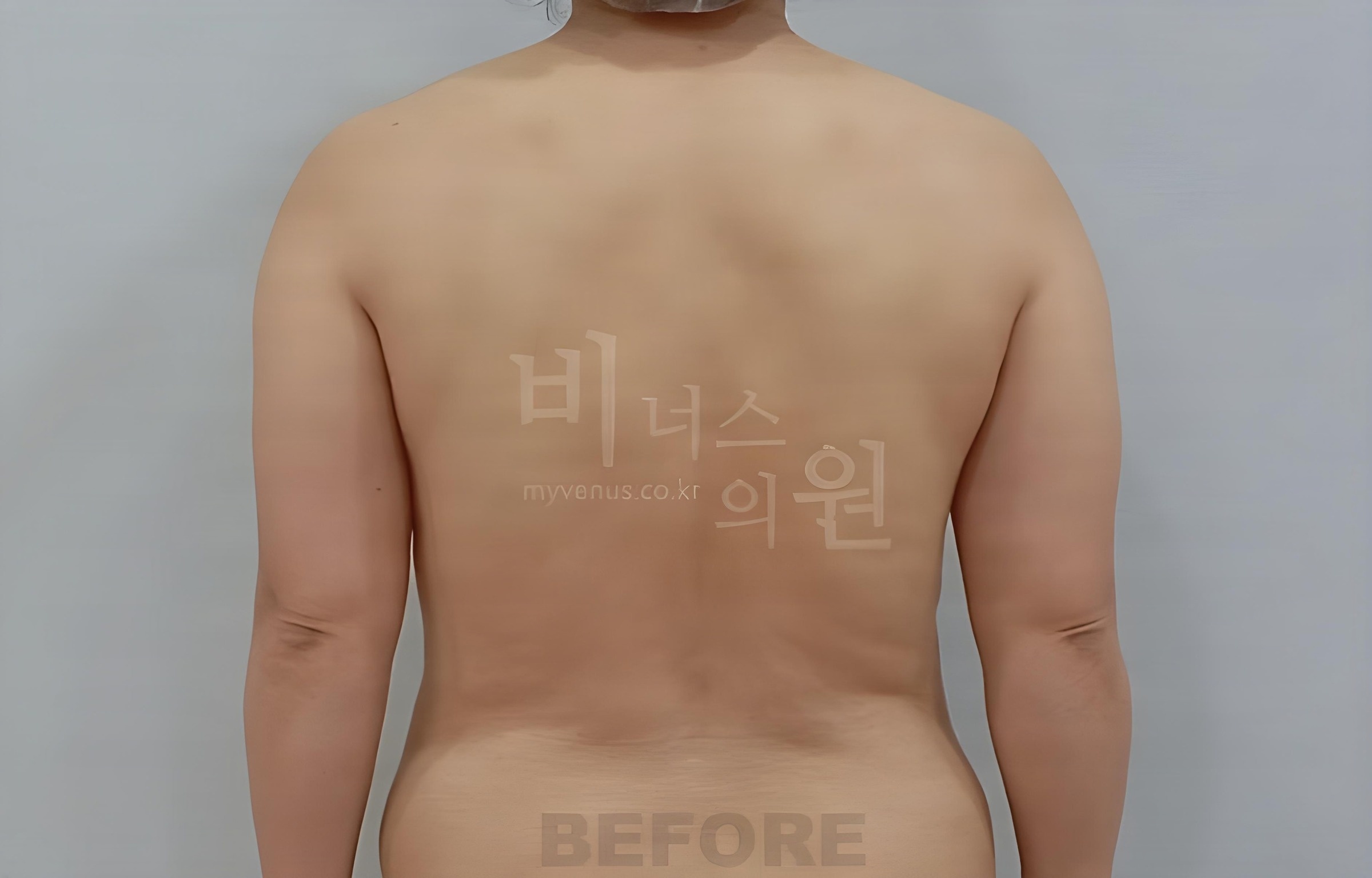 팔뚝 지방흡입 수술 전 후면 팔을 내린 비너스의원