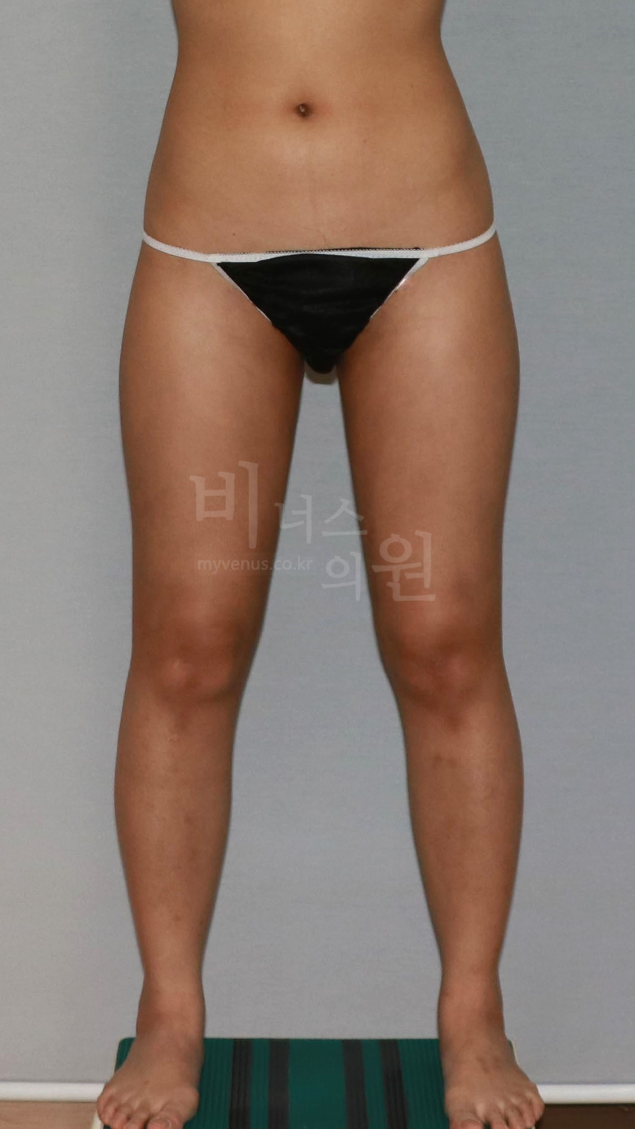 허벅지 안쪽 지방흡입 수술 후 정면 다리벌림 비너스의원