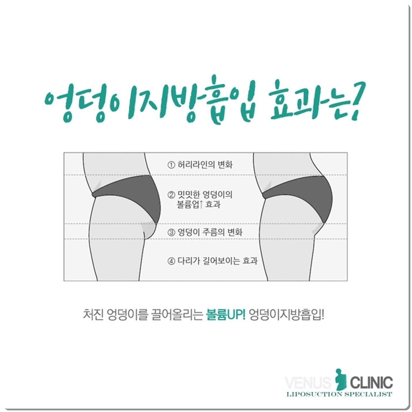 엉덩이 지방흡입·지방이식 수술 관련 이미지