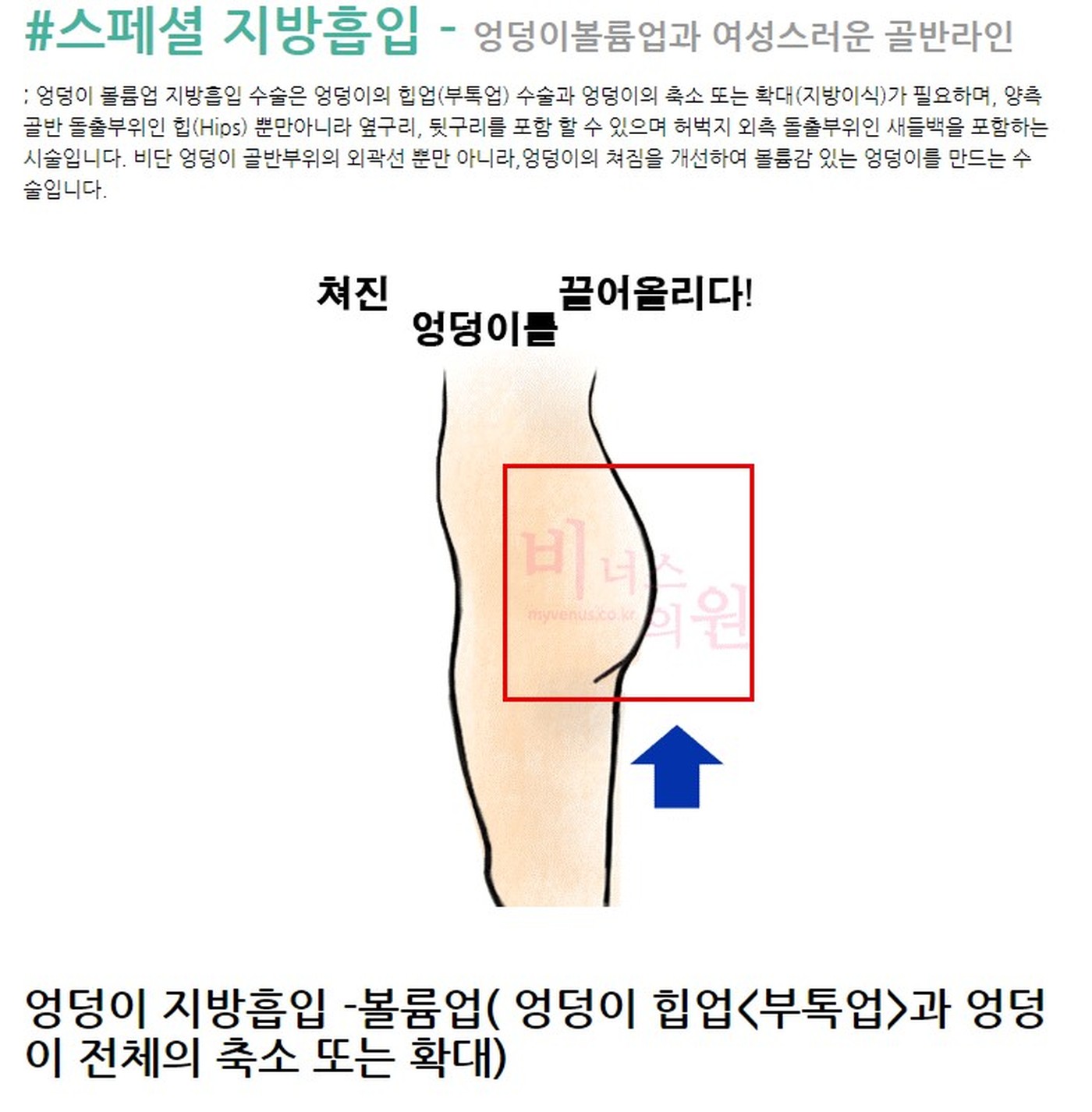 엉덩이 지방흡입(힙소) 수술 관련 이미지