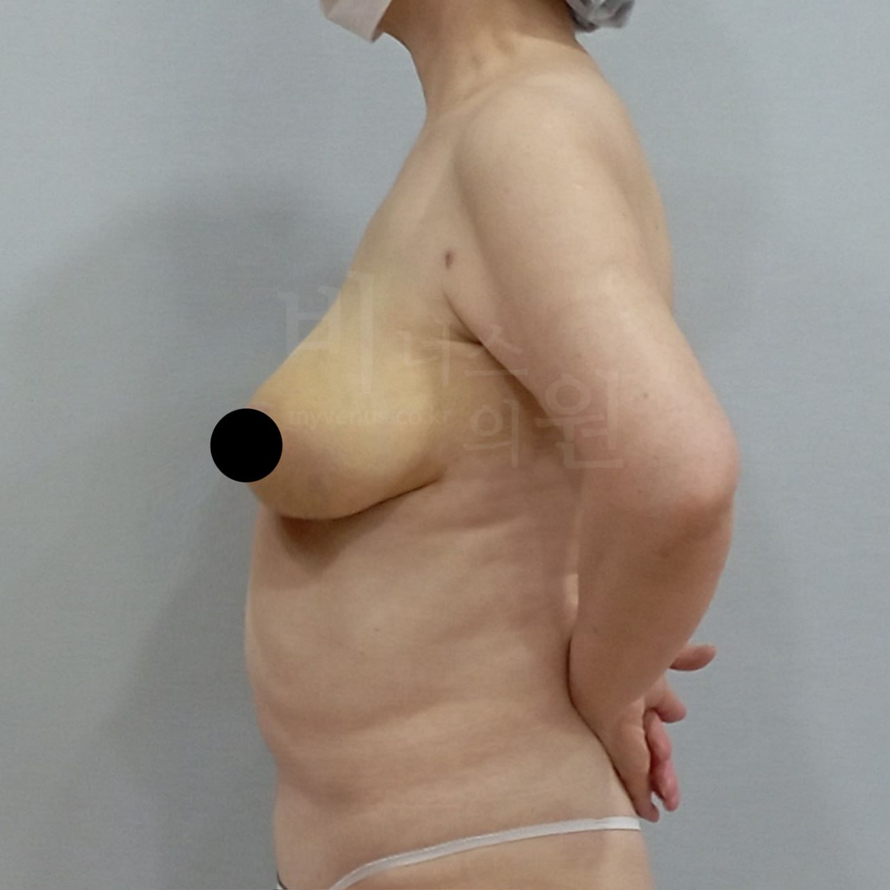 가슴축소 지방흡입 수술 후 측면 비너스의원