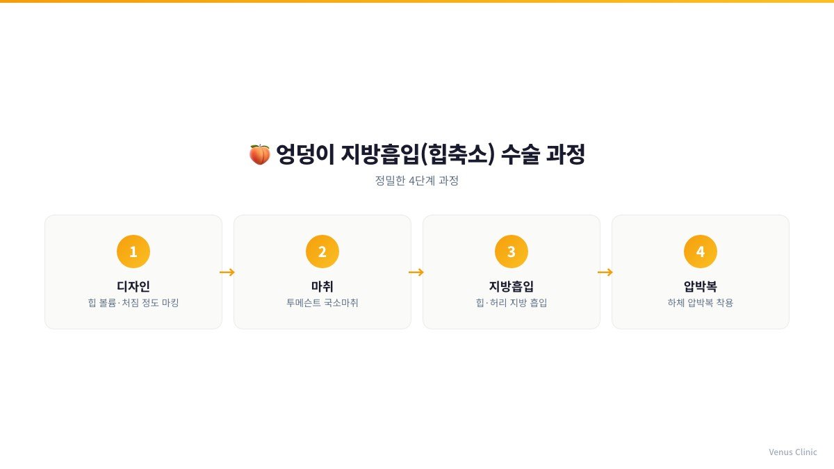 엉덩이 지방흡입 수술 4단계 인포그래픽 - 디자인, 마취, 지방흡입, 압박복