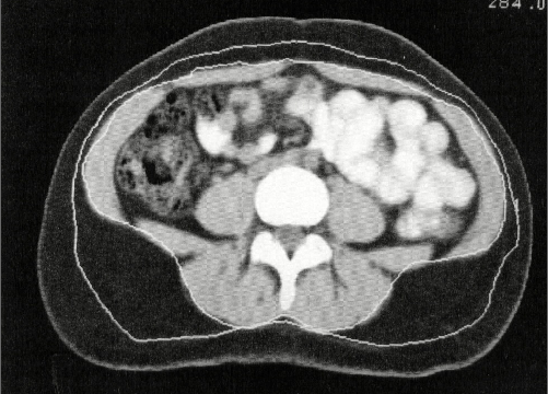 복부 내장지방 CT 사진