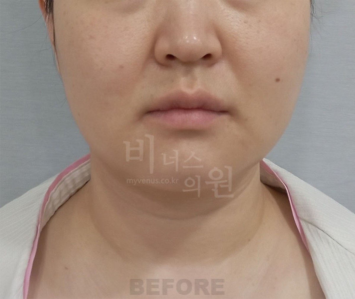 이중턱 턱 목 지방흡입 수술 전 정면 비너스의원