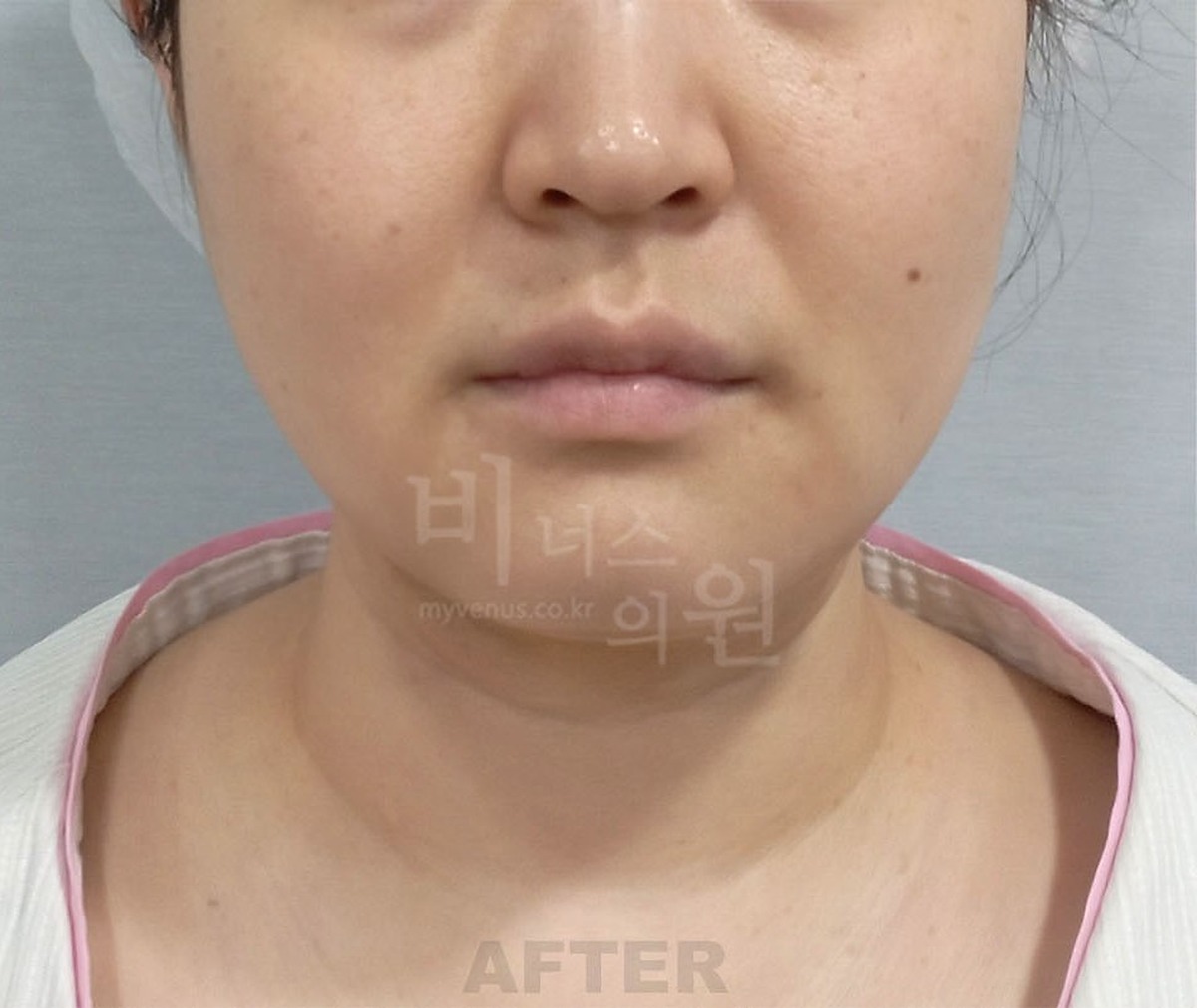 이중턱 턱 목 지방흡입 수술 후 정면 비너스의원