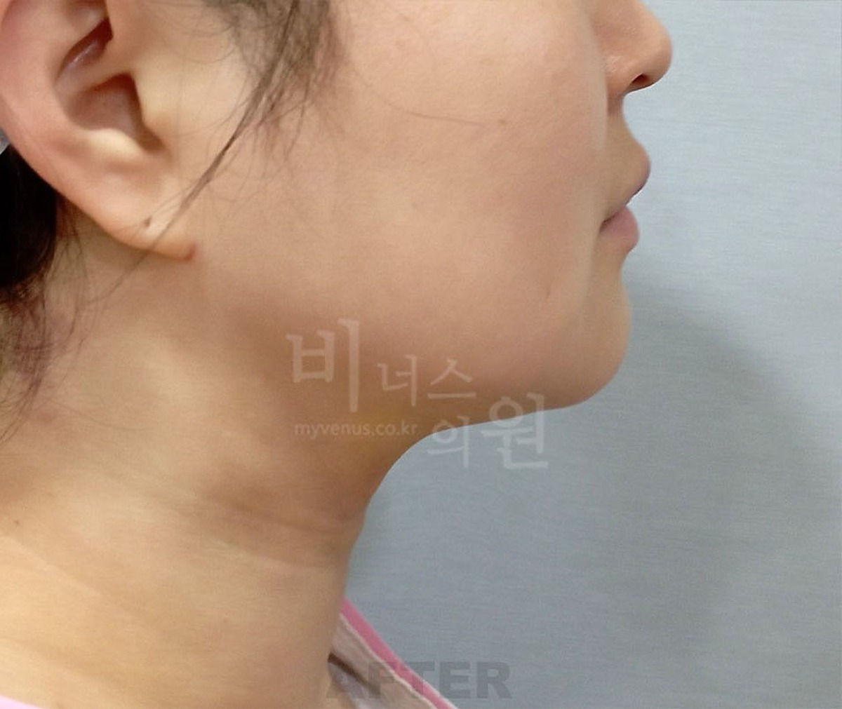 이중턱 턱 목 지방흡입 수술 후 반대쪽 측면 비너스의원