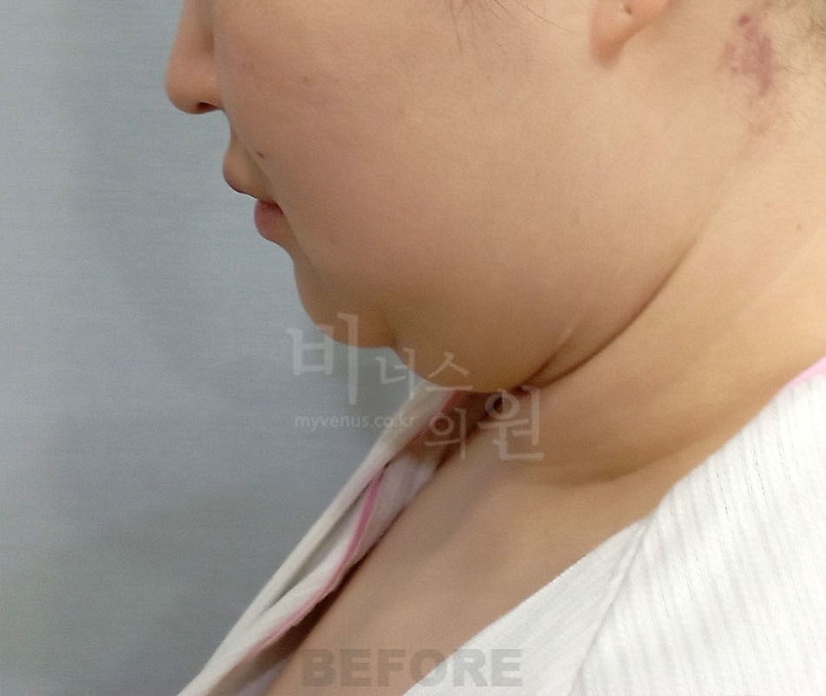 이중턱 턱 목 지방흡입 수술 전 측면 비너스의원