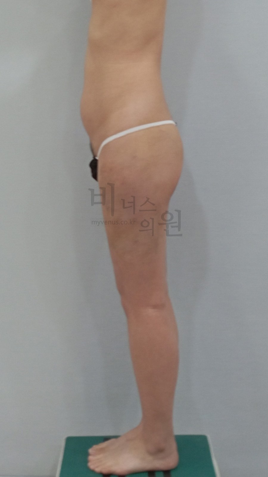 엉덩이축소 지방흡입 수술 후 좌측면 비너스의원