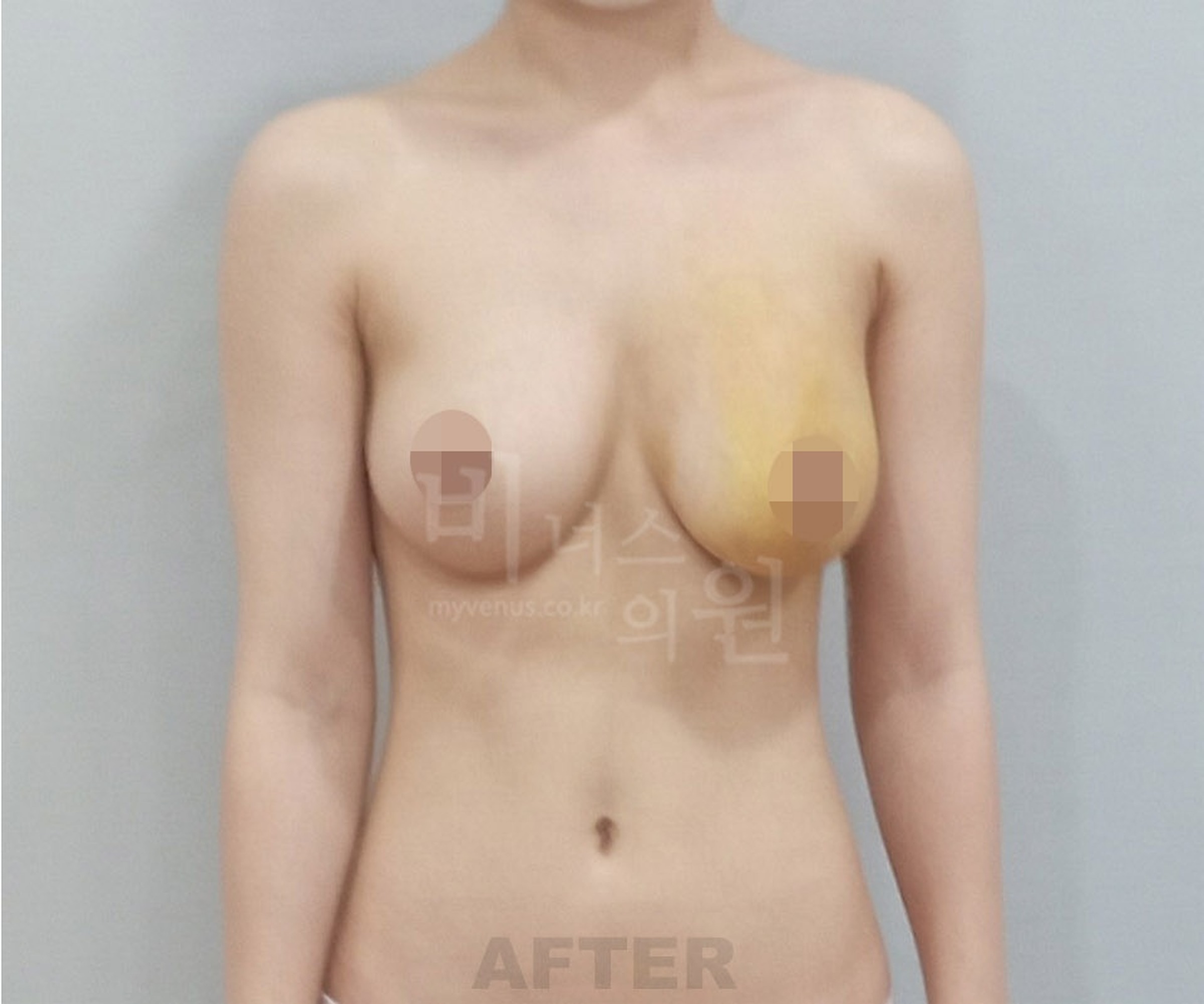 가슴축소 지방흡입 수술 후 정면 비너스의원