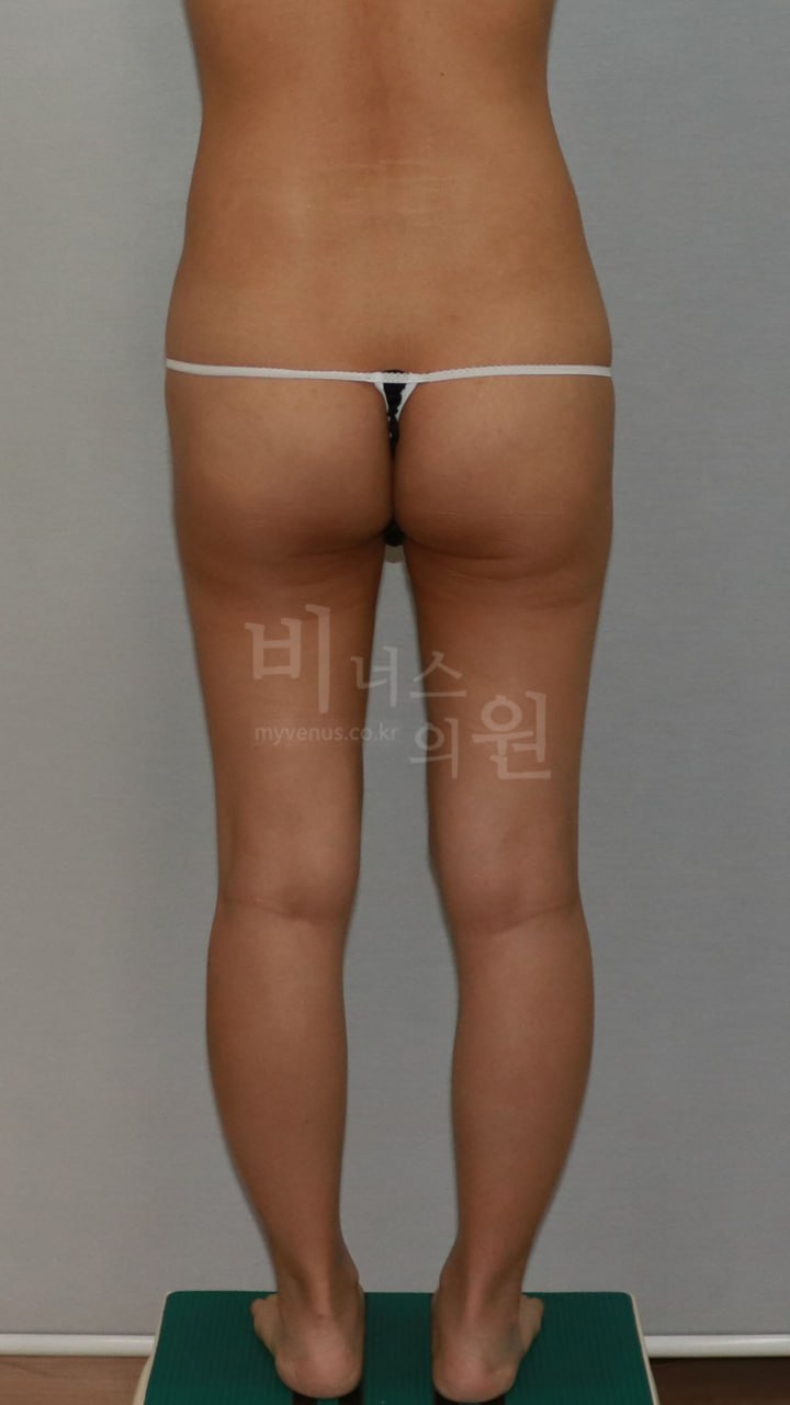엉덩이 지방흡입 수술 전 — 후면 | 비너스의원
