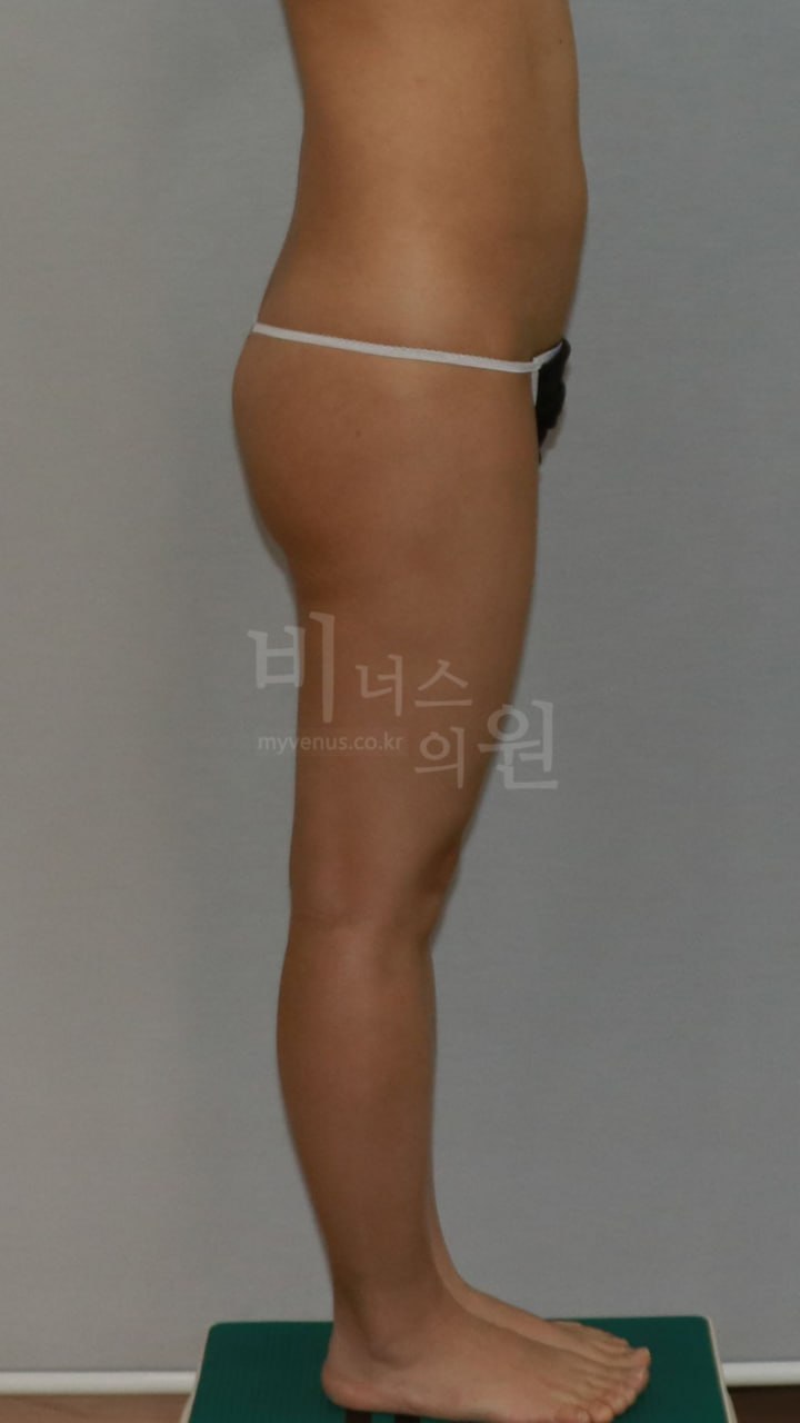 엉덩이 지방흡입 수술 전 — 측면 (2) | 비너스의원