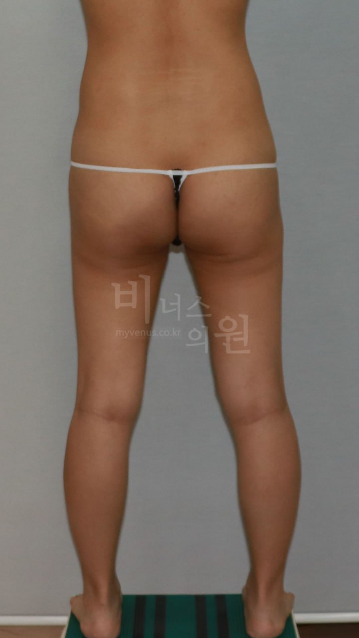 엉덩이 지방흡입 수술 전 — 후면 (2) | 비너스의원