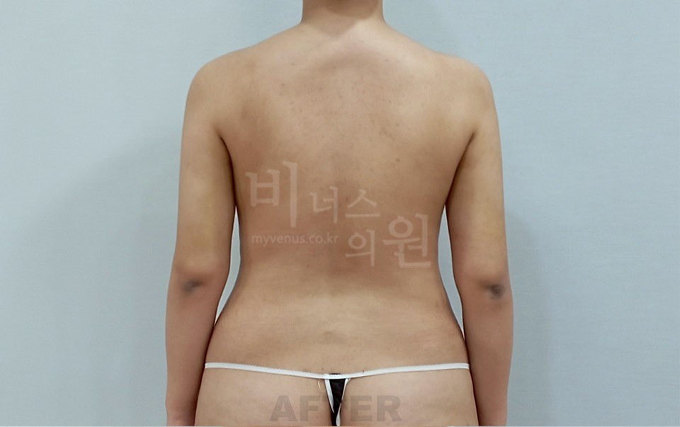 팔뚝 지방흡입 수술 후 후면 팔 내림 비너스의원