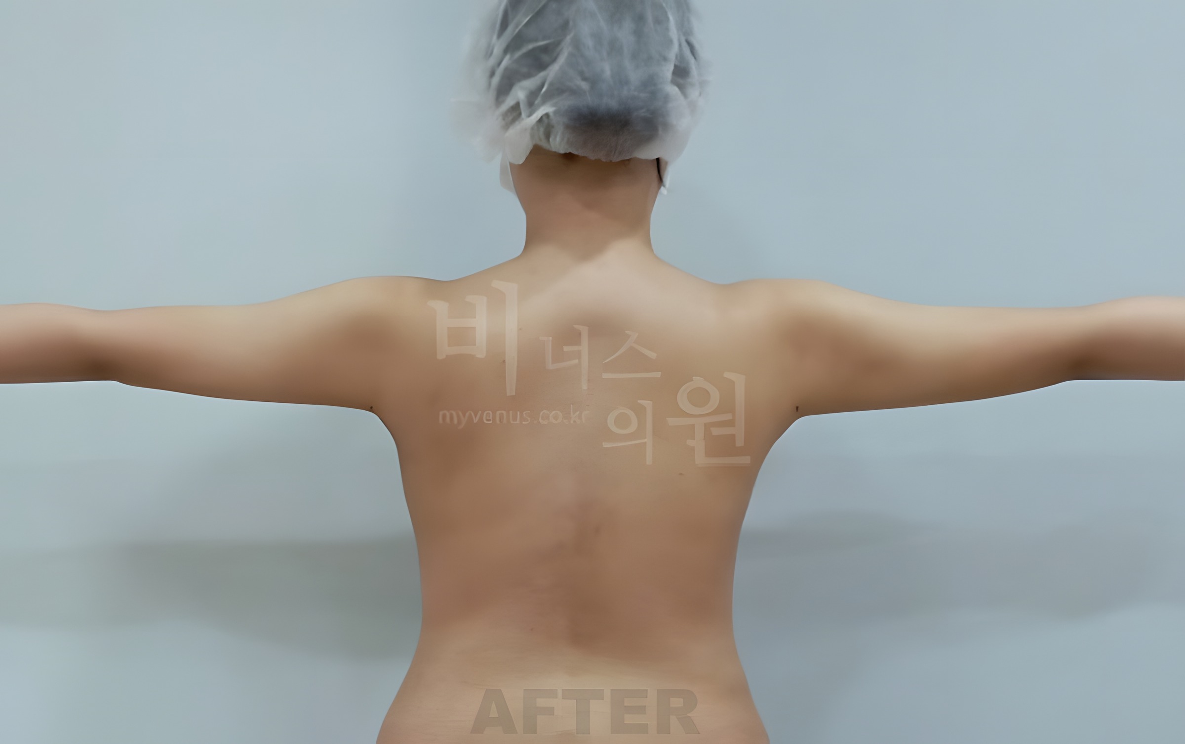 팔뚝 지방흡입 수술 후 후면 팔 벌리기 비너스의원