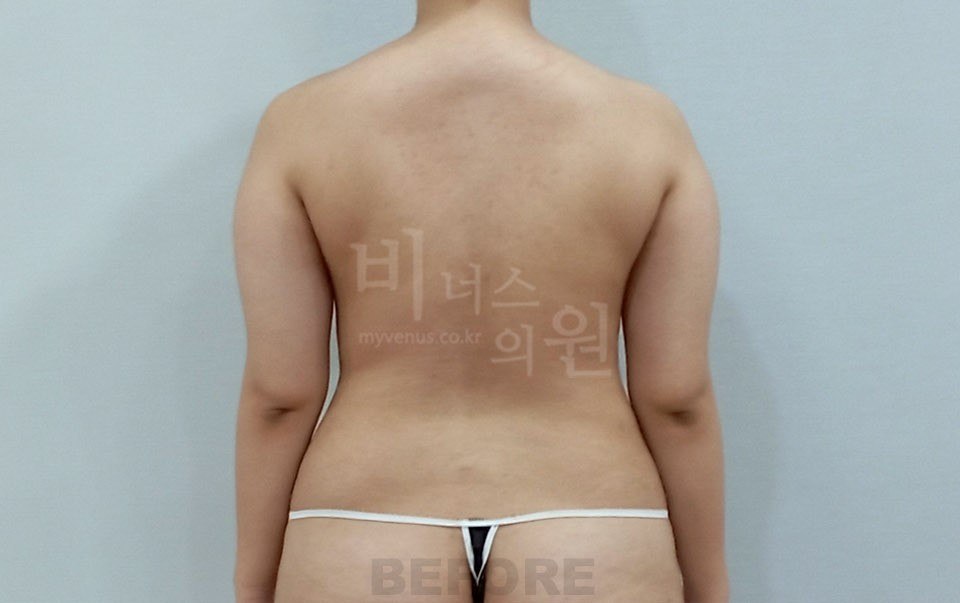 팔뚝 지방흡입 수술 전 후면 팔 내림 비너스의원
