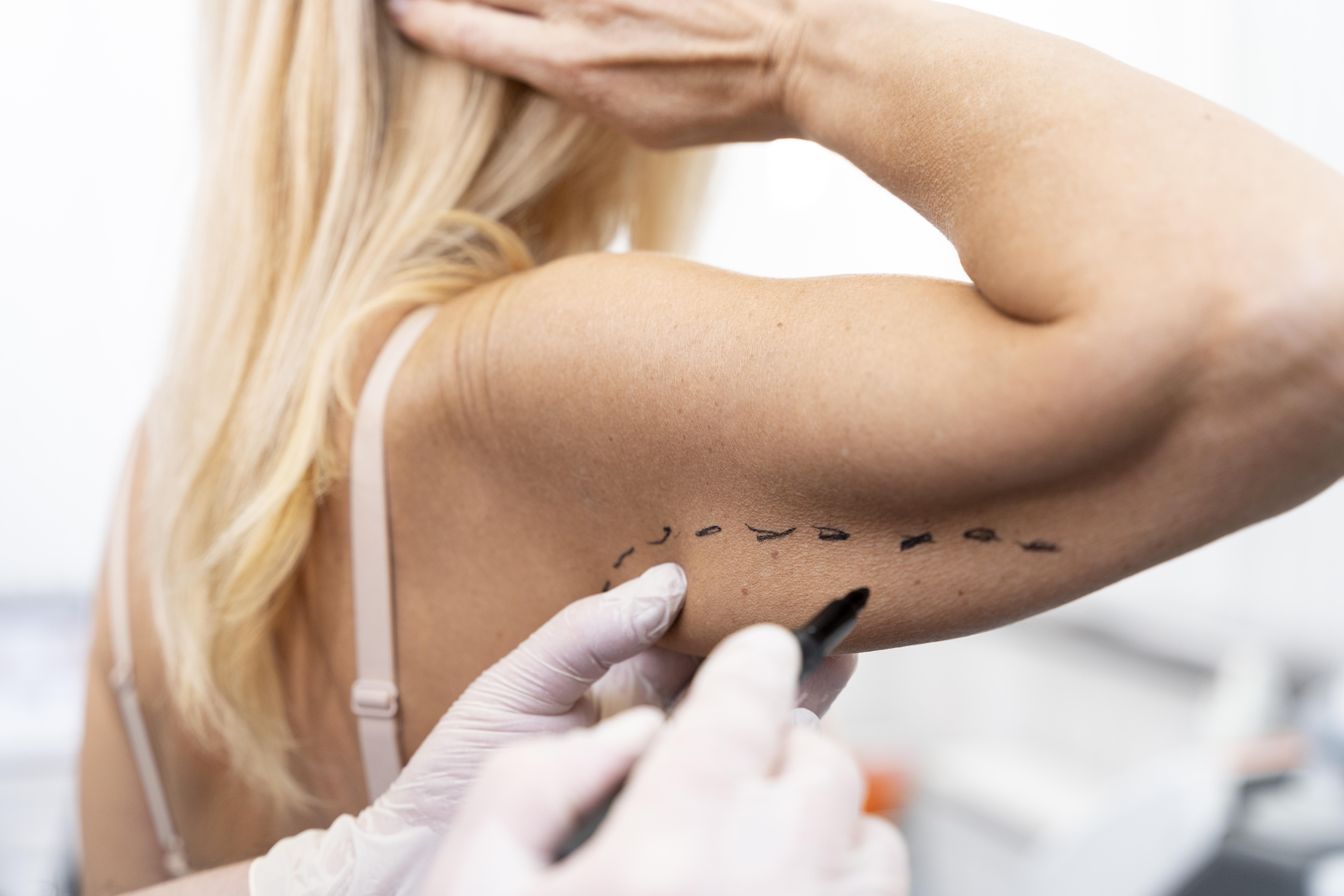 팔뚝살 체형 고민 팔 지방흡입 비너스의원