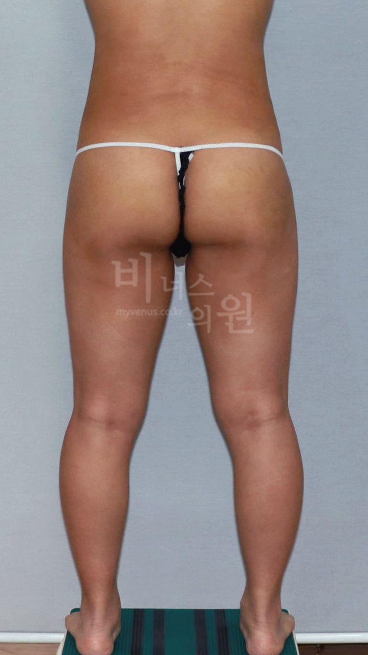 엉덩이축소 지방흡입 전후사진 케이스2 후면 수술후 비너스의원