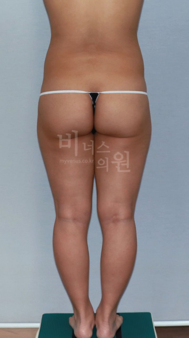 엉덩이축소 지방흡입 전후사진 케이스1 후면 수술전 비너스의원