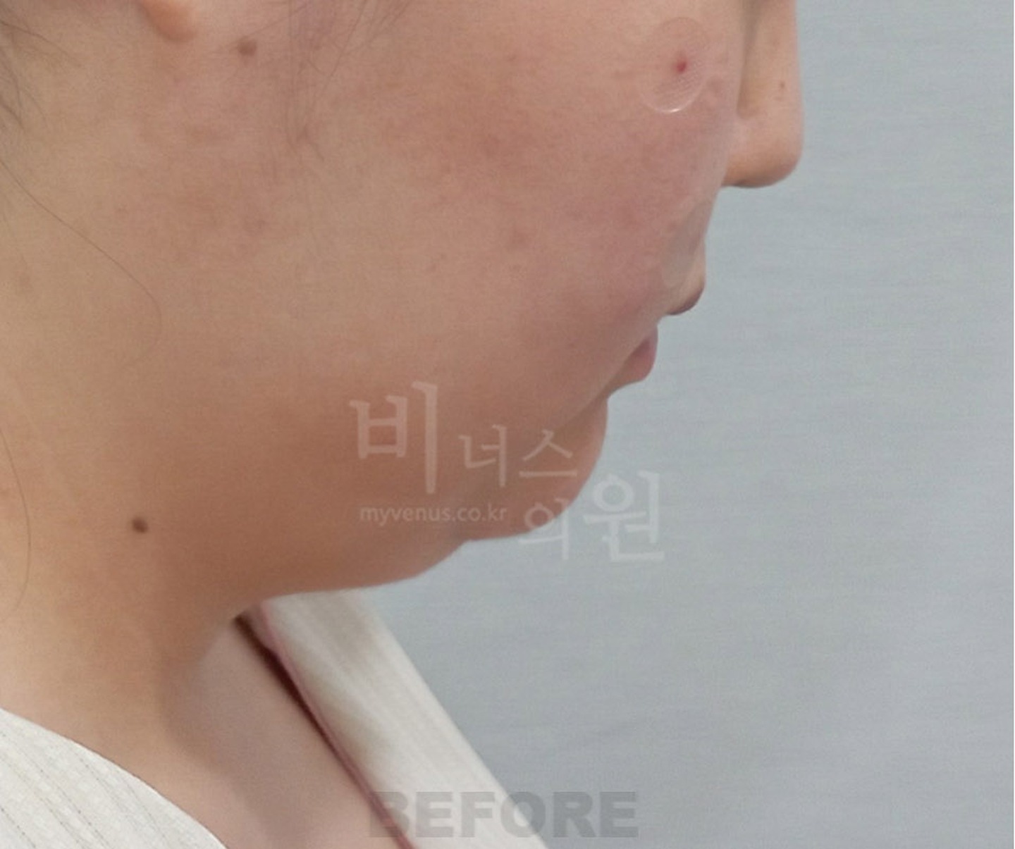 턱 이중턱 목 얼굴 지방흡입 수술 전 45도 측면 ② 비너스의원
