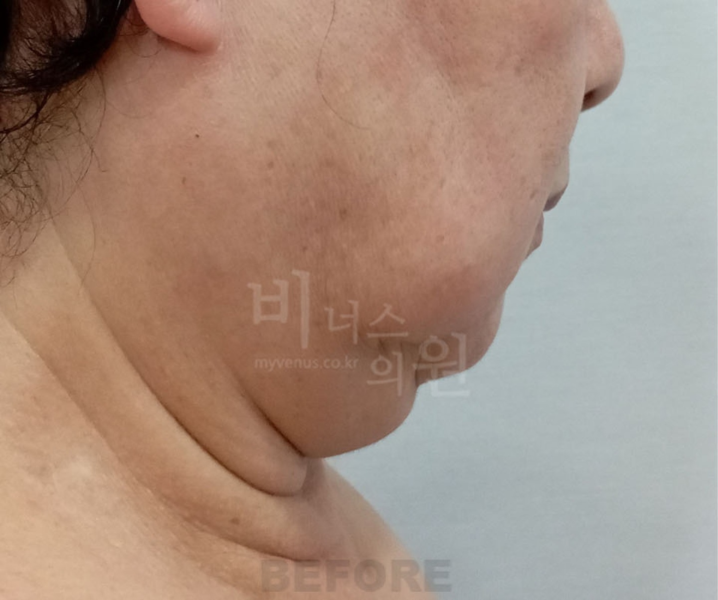 볼 턱 목 이중턱 얼굴 지방흡입 수술 전 45도 측면 ② 비너스의원