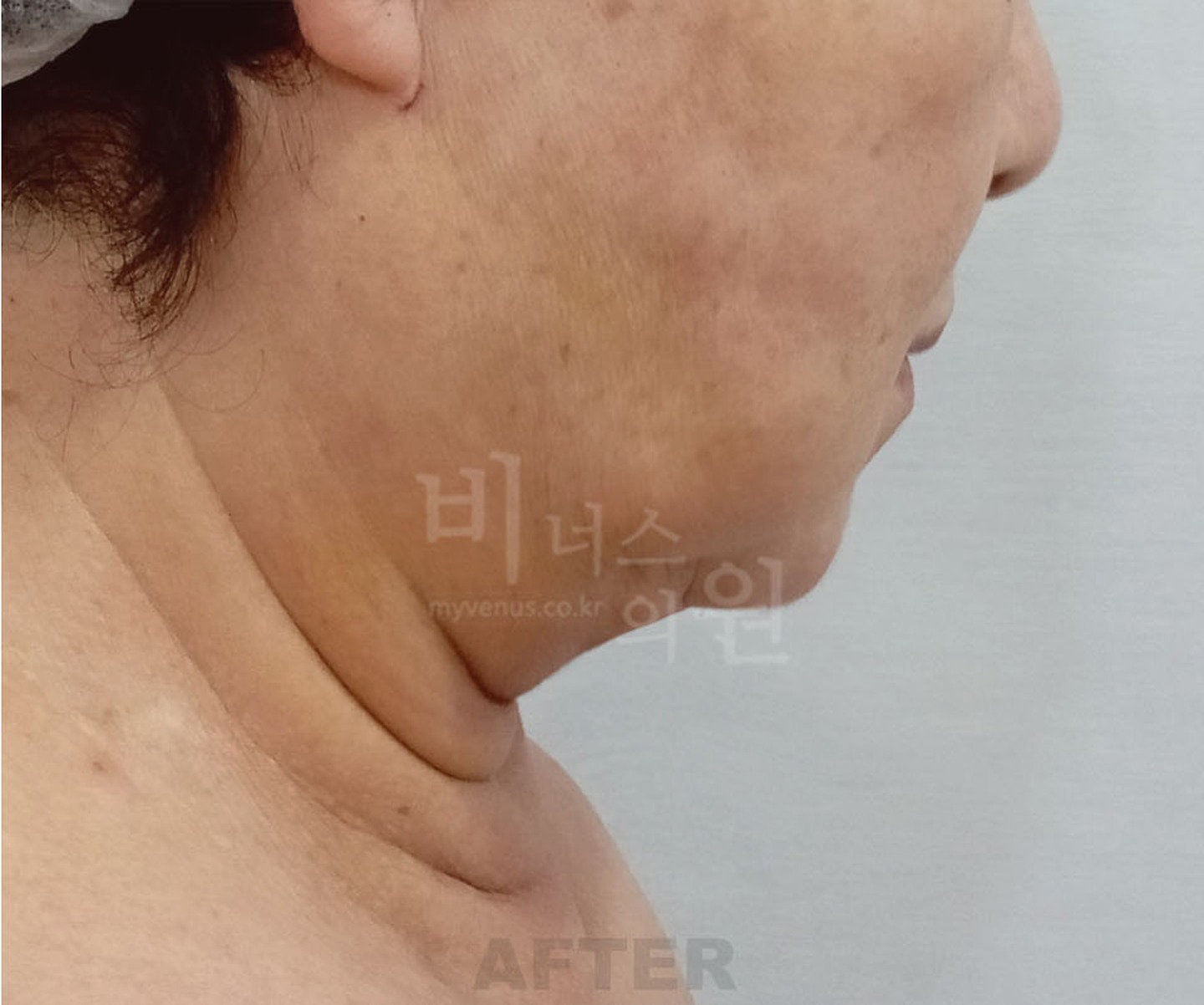 볼 턱 목 이중턱 얼굴 지방흡입 수술 후 45도 측면 ② 비너스의원