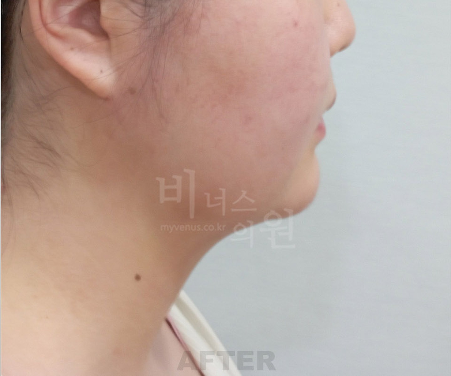 턱 이중턱 목 얼굴 지방흡입 수술 후 측면 ② 비너스의원