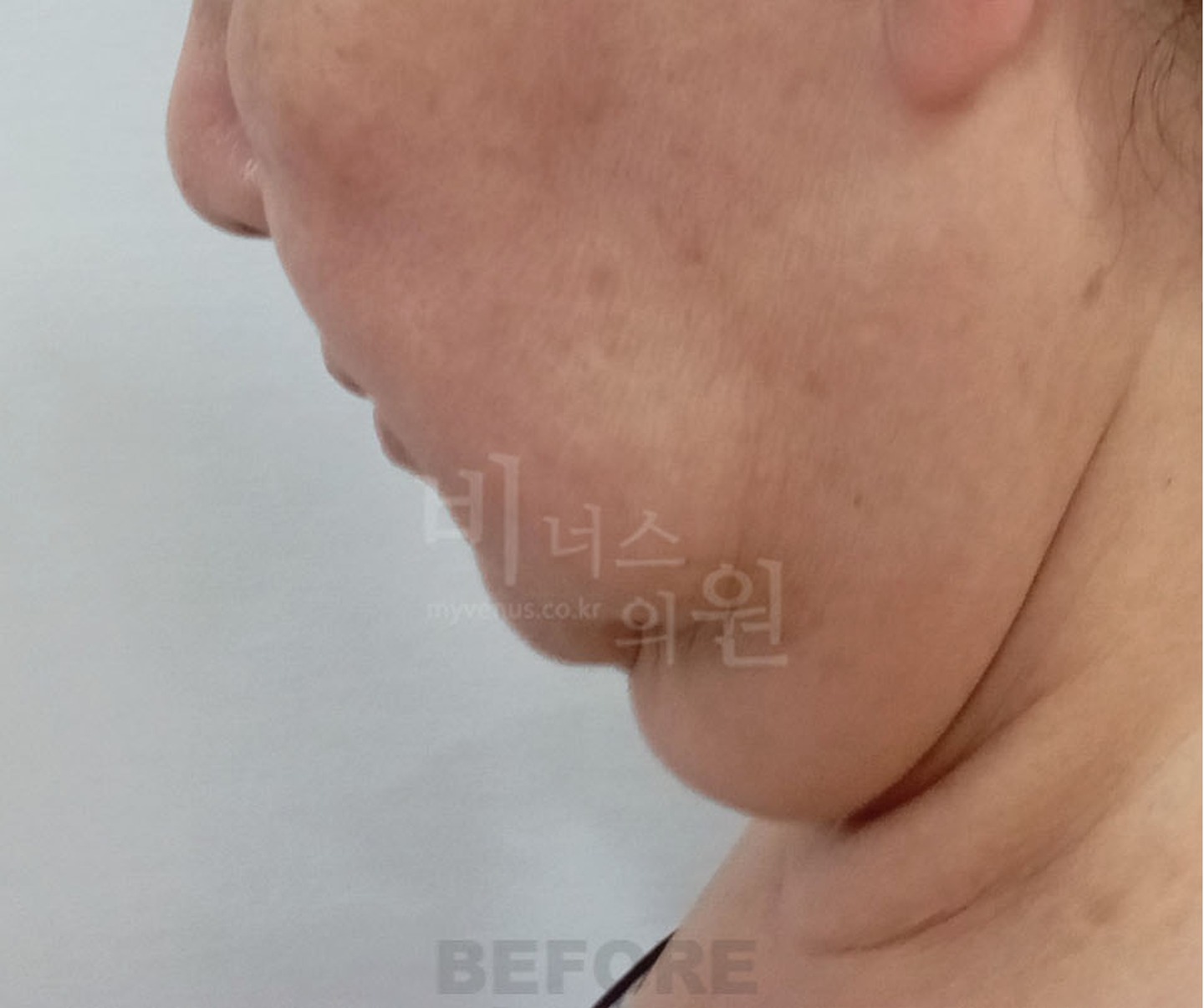 볼 턱 목 이중턱 얼굴 지방흡입 수술 전 45도 측면 ① 비너스의원