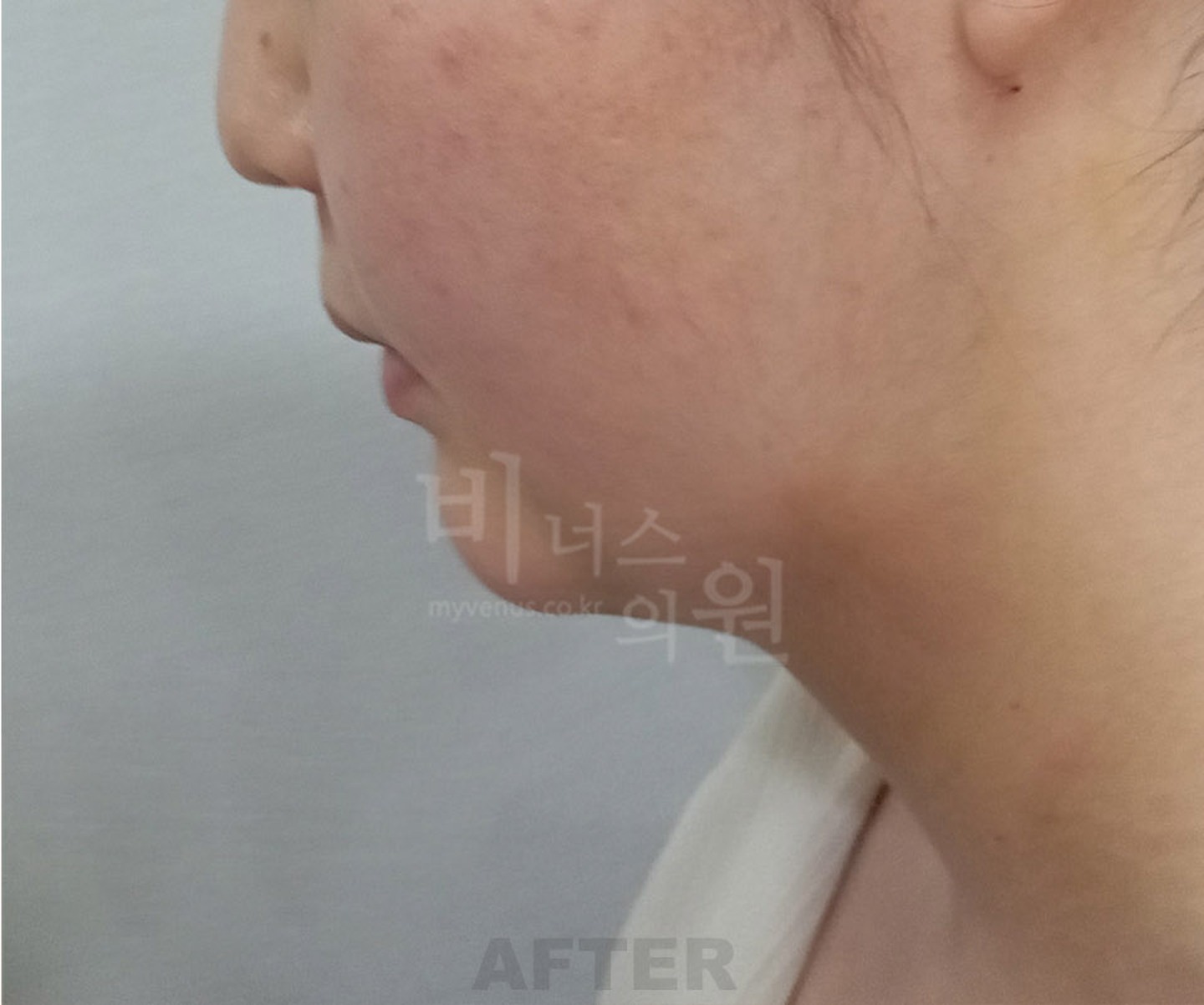 턱 이중턱 목 얼굴 지방흡입 수술 후 45도 측면 ① 비너스의원