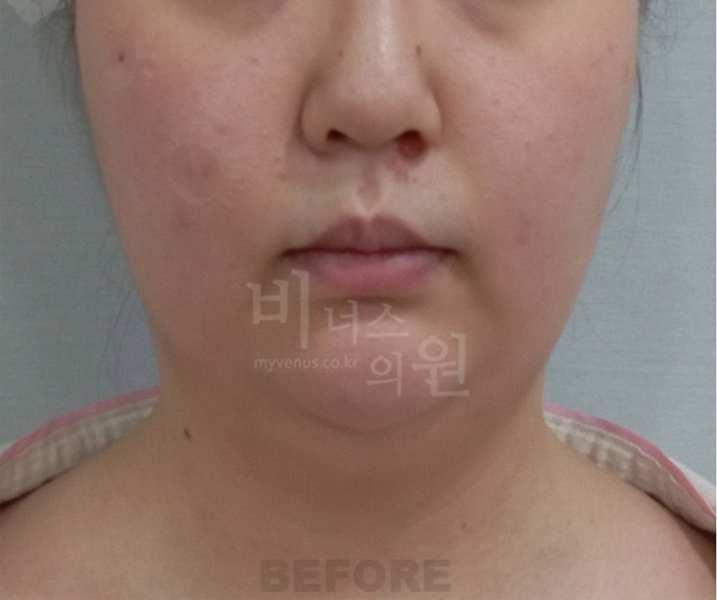 턱 이중턱 목 얼굴 지방흡입 수술 전 정면 비너스의원