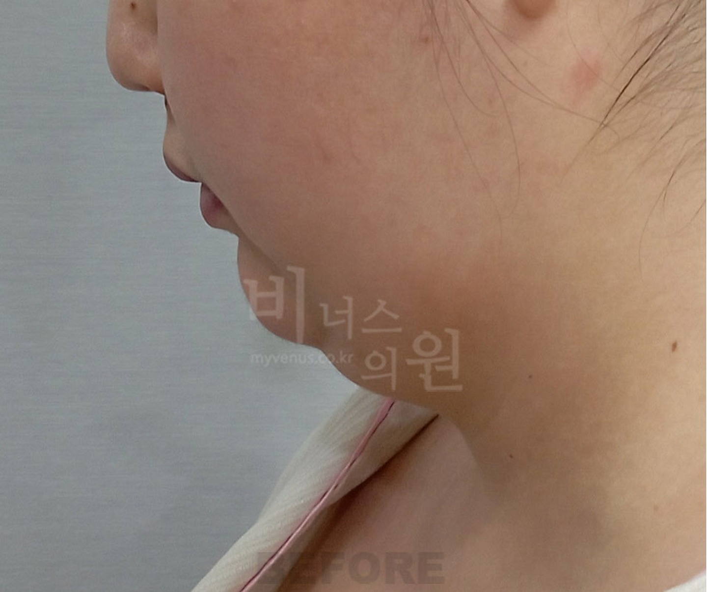 턱 이중턱 목 얼굴 지방흡입 수술 전 45도 측면 ① 비너스의원