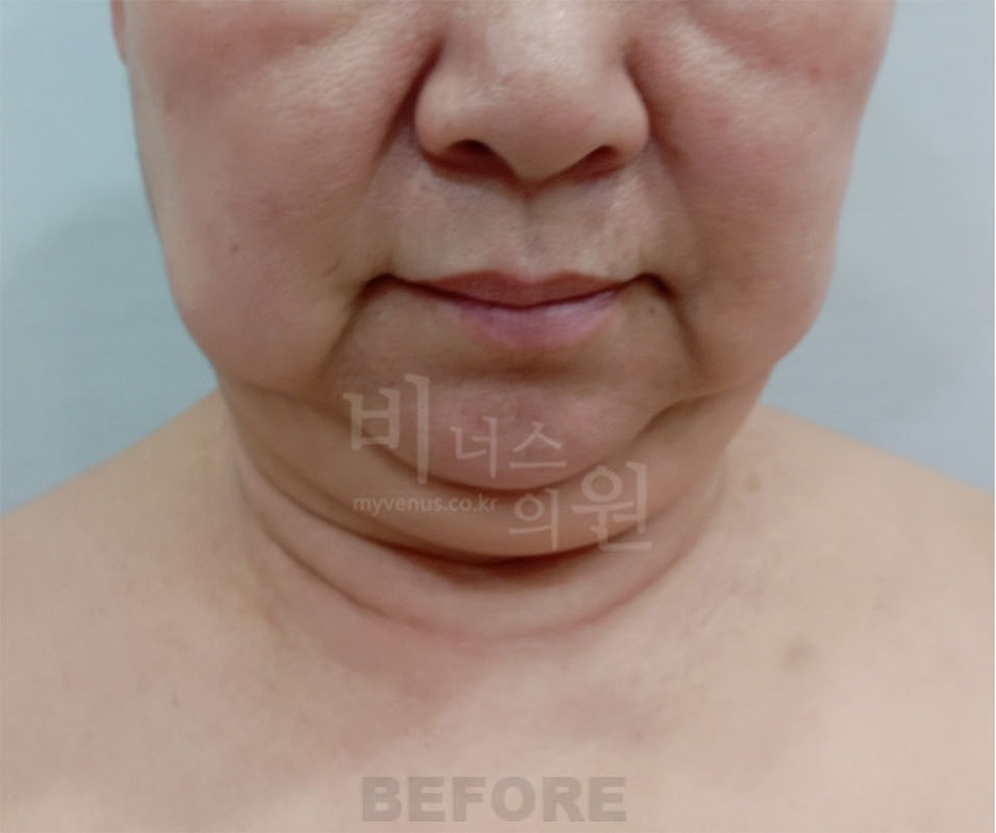 볼 턱 목 이중턱 얼굴 지방흡입 수술 전 정면 비너스의원