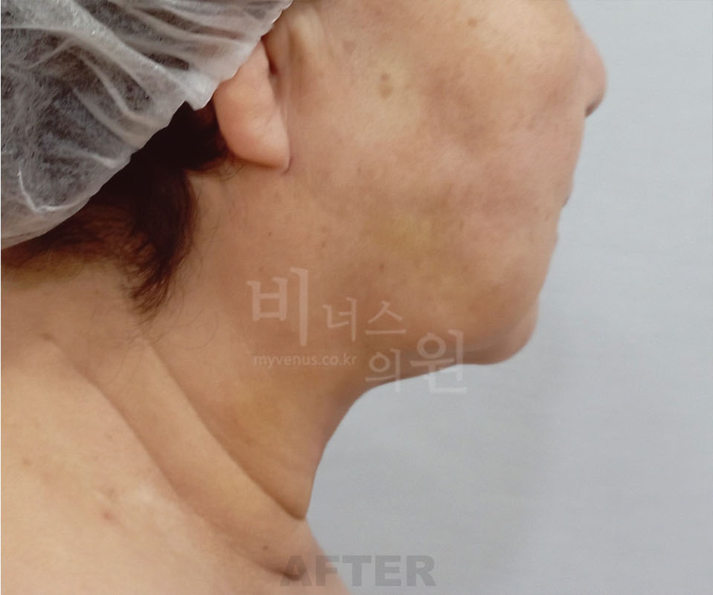 볼 턱 목 이중턱 얼굴 지방흡입 수술 후 측면 ② 비너스의원