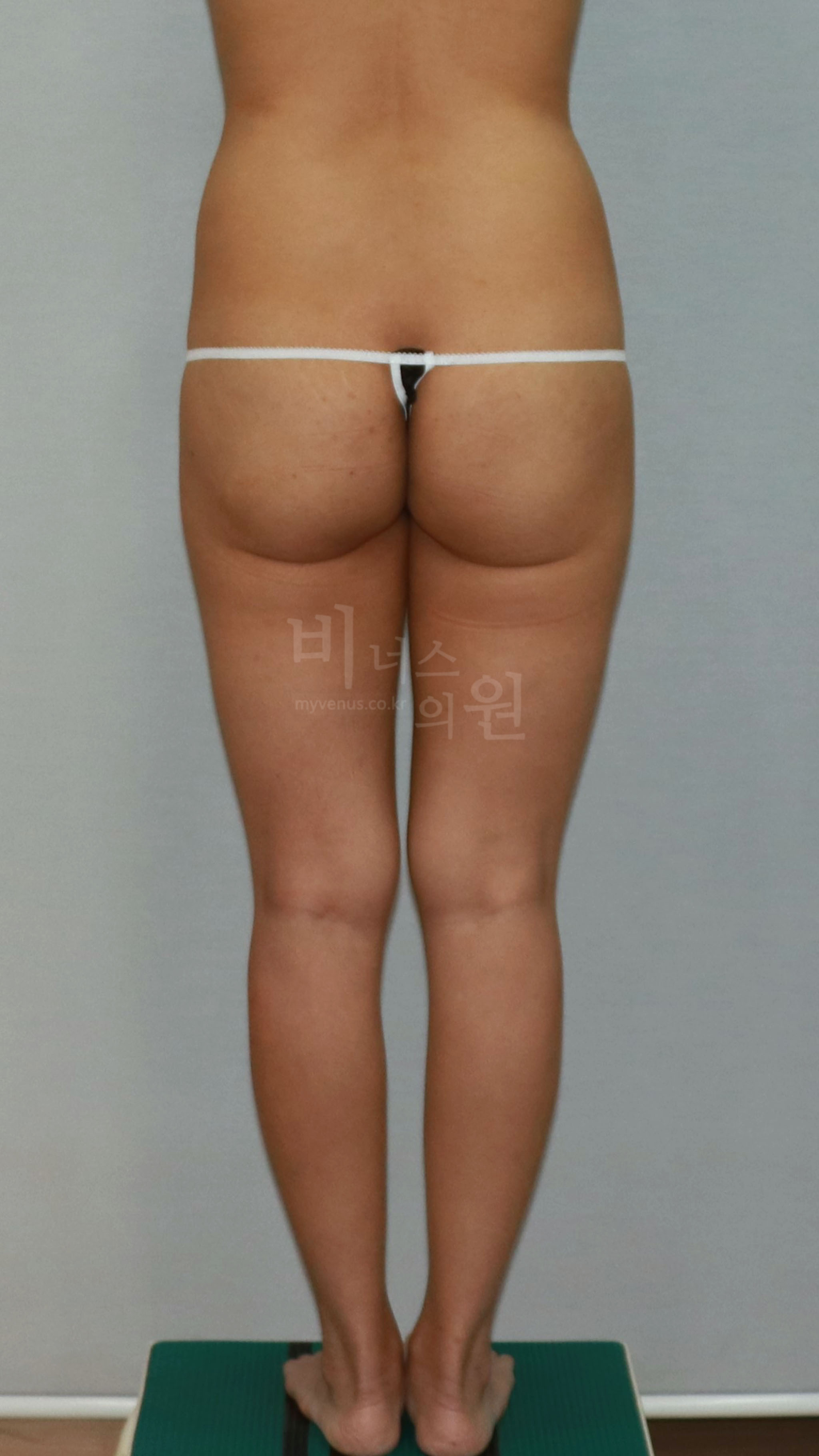 엉덩이축소 지방흡입 수술 전 후면 비너스의원