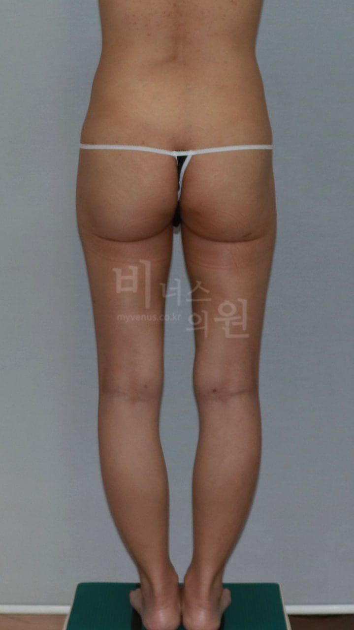 엉덩이 볼륨업 지방흡입 수술 전 후면 비너스의원