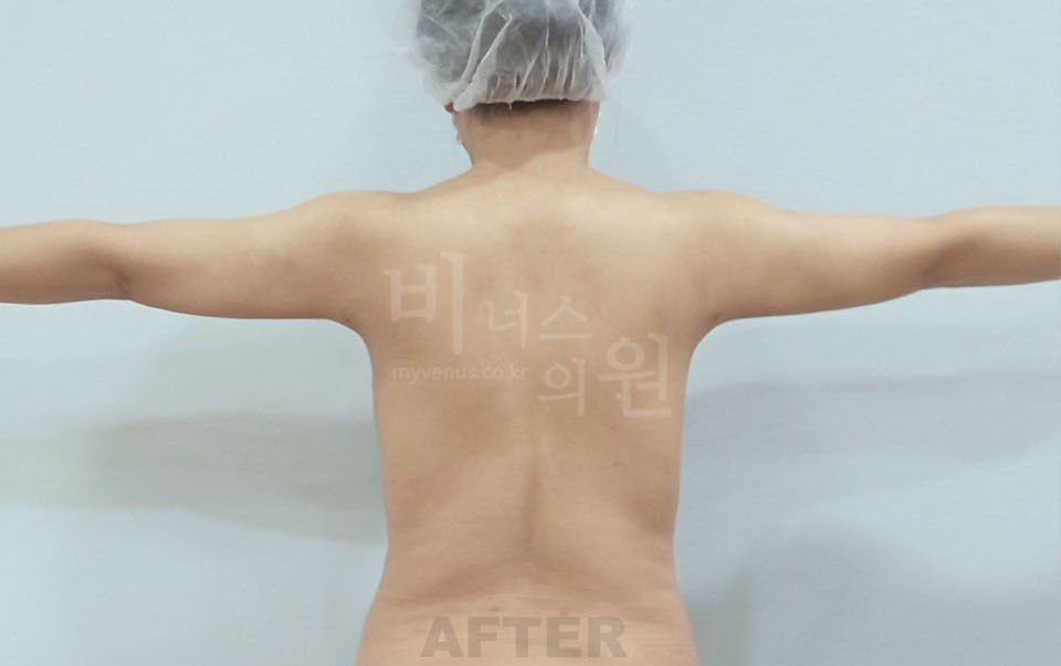 팔등 지방흡입 후 후면 비너스의원