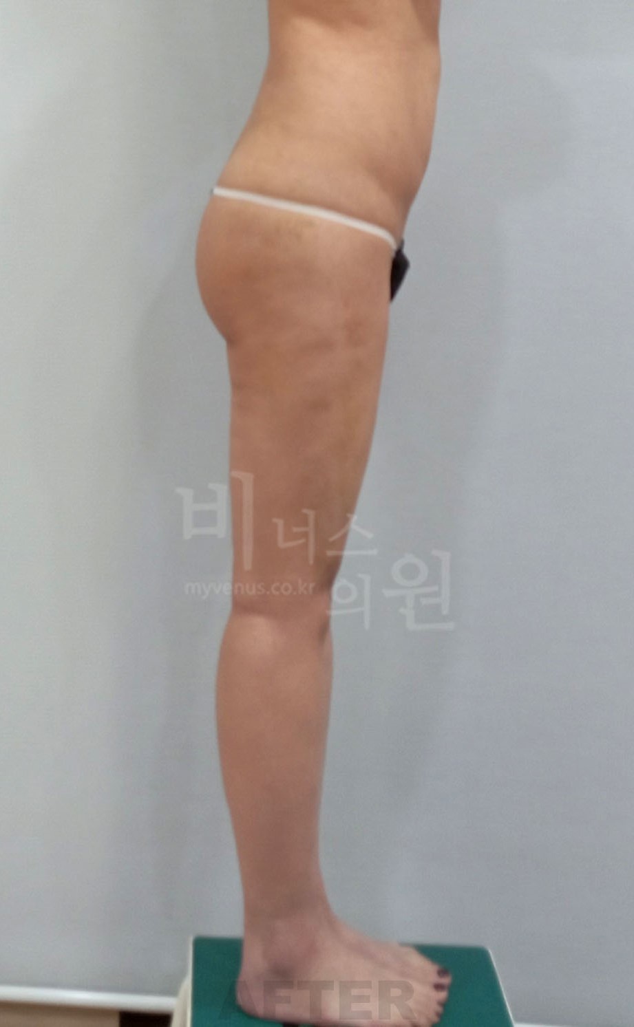 엉덩이축소 지방흡입 수술 후 좌측면 비너스의원